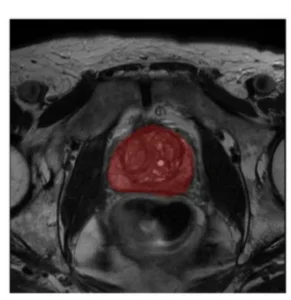 AI-ADC: Channel and Spatial Attention-Based Contrastive Learning to Generate ADC Maps from T2W MRI for Prostate Cancer Detection